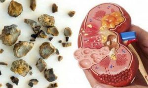 ciri-ciri-ginjal-kotor-647x375